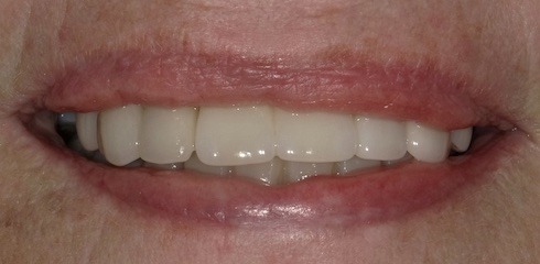Marie's Case after treatment
