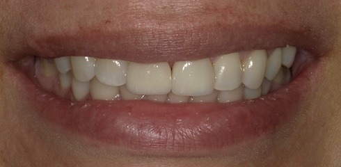 Julia's Case after treatment