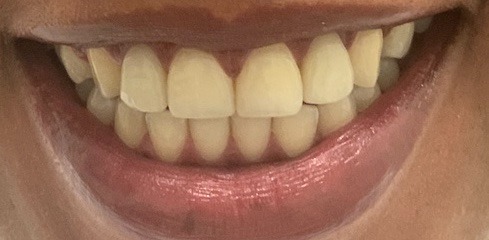 Linet's Case after treatment