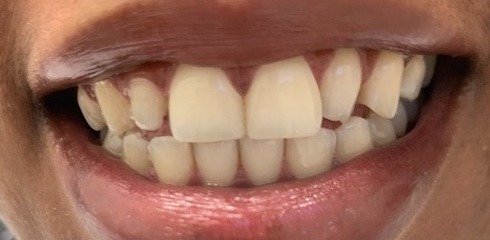 Linet's Case before treatment
