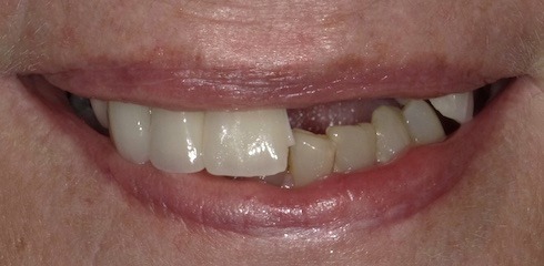 Marie's Case before treatment